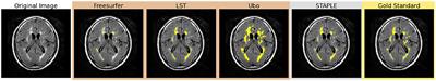 Multi-stage semi-supervised learning enhances white matter hyperintensity segmentation